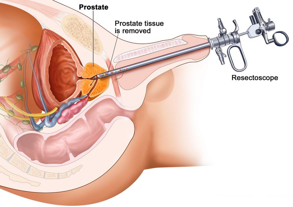 Entnahme von Prostatagewebe zur genauen Diagnose einer Prostatitis