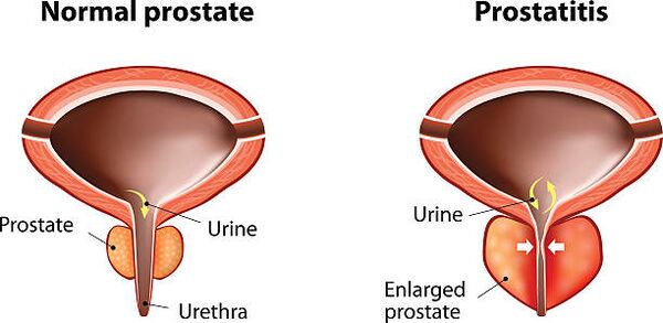 normale und entzündete Prostata